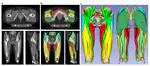 Artificial intelligence-based volumetric analysis of muscle atrophy and fatty degeneration in patients with hip osteoarthritis and its correlation with health-related quality of life