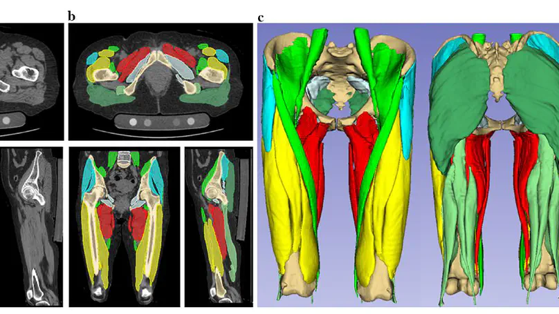 Artificial intelligence-based volumetric analysis of muscle atrophy and fatty degeneration in patients with hip osteoarthritis and its correlation with health-related quality of life